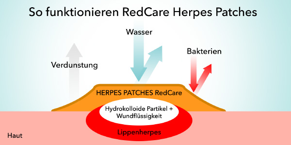 Wirkungsweise der Herpes Patches